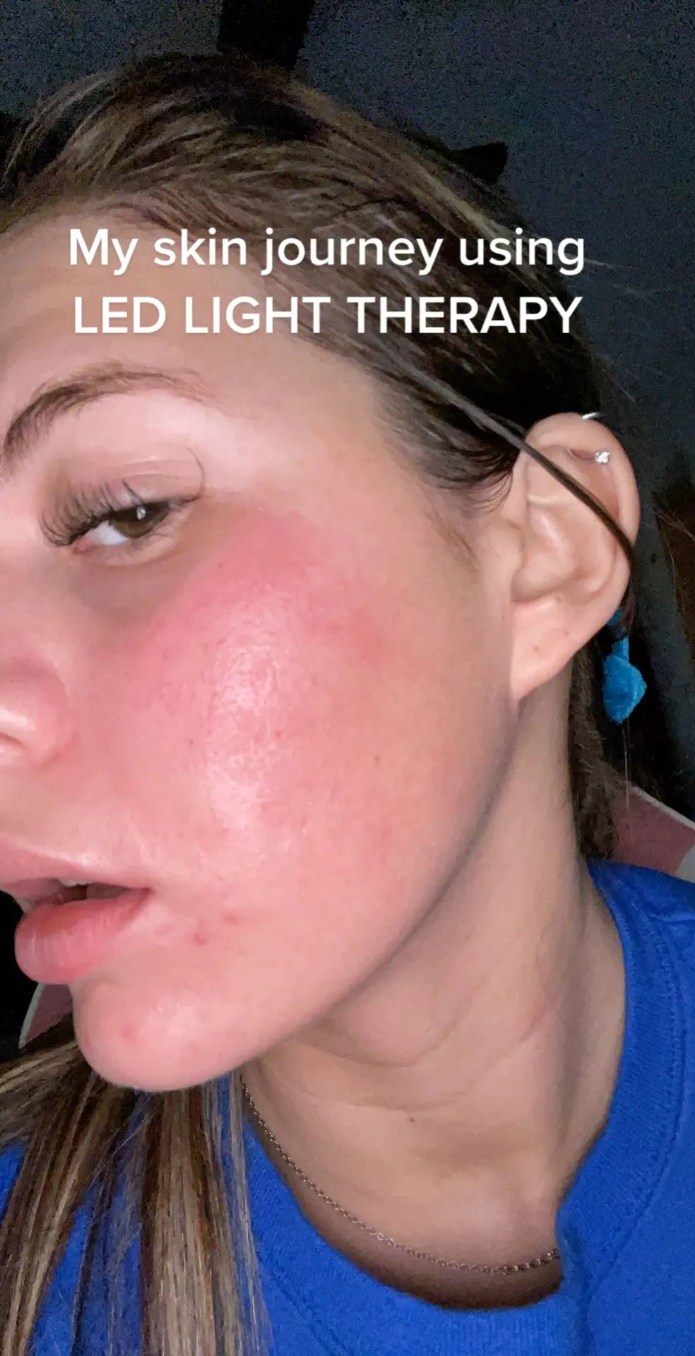 INNOWAVE™ LED Light Therapy Mask