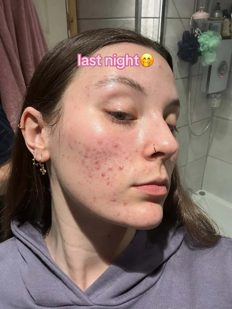 INNOWAVE™ LED Light Therapy Mask
